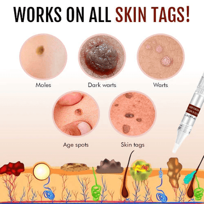 🎁BUY 1 GET 1 FREE🎁WipeOff™ Tags & Moles Remover - Emporium Shop